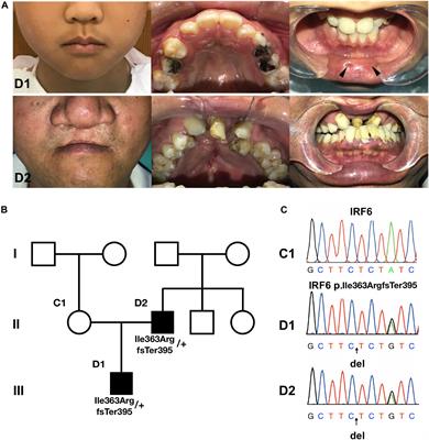 Functional Characterization of a Novel IRF6 Frameshift Mutation From a Van Der Woude Syndrome Family